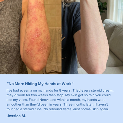 Eczema & Psoriasis Cream