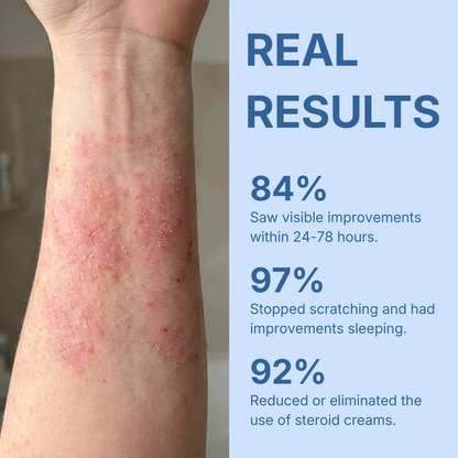 Eczema & Psoriasis Cream